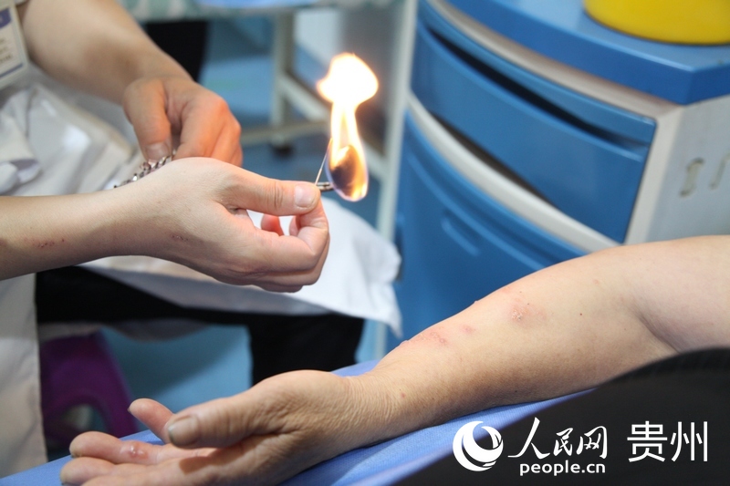 程明慶用火療法為患者治療帶狀皰疹。人民網記者 王秀芳攝