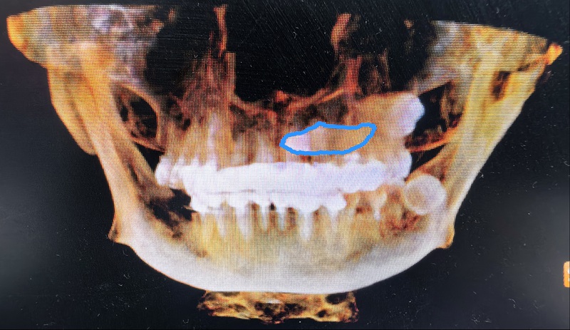 術(shù)前:尖牙橫行貫穿埋伏于左上頜骨內(nèi),牙冠位于上腭,牙根位于鼻根側(cè)下方。