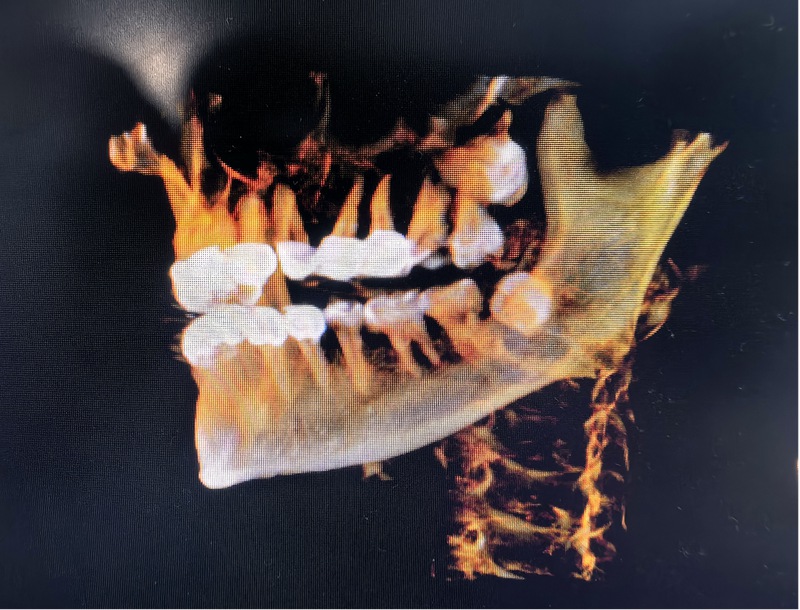 術(shù)后:鄰牙、神經(jīng)、鼻腔及上頜竇粘膜均無(wú)損傷。