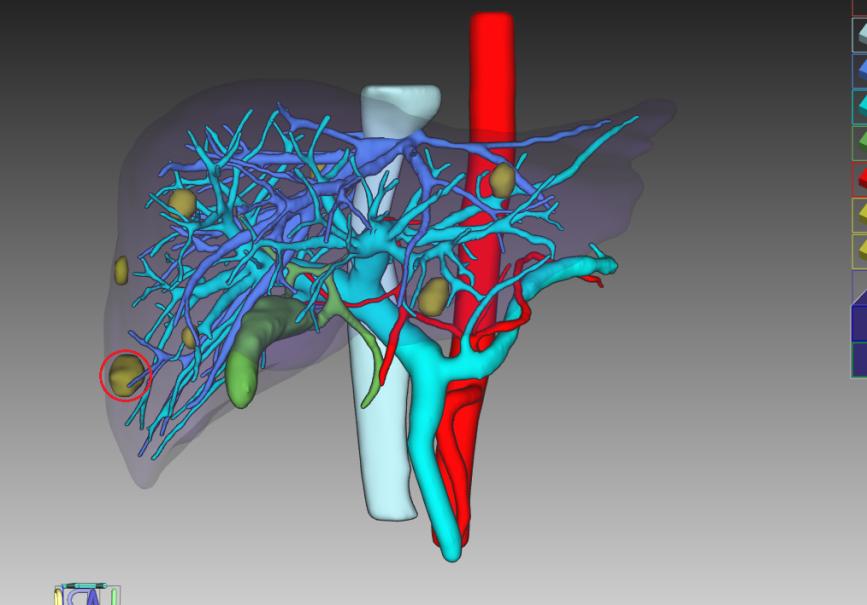 術(shù)前全量化三維重建。
