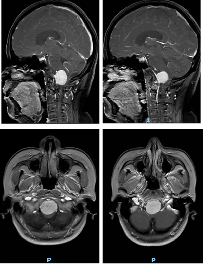 罕見腫瘤深藏“生命中樞”風險極高。