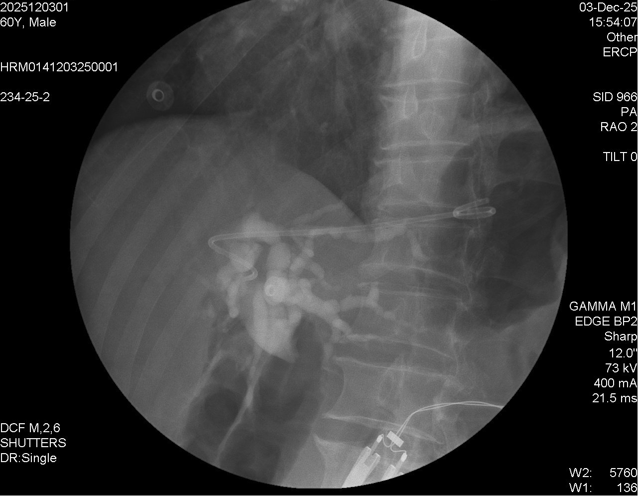肝內(nèi)膽管與胃之間支架置入后。