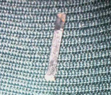 患者顱內的金屬。