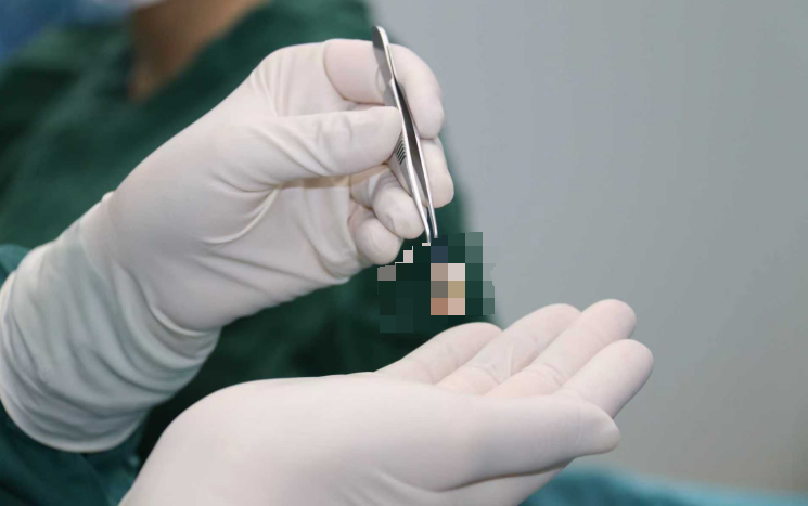 角膜源跨省馳援 患者正在接受手術。